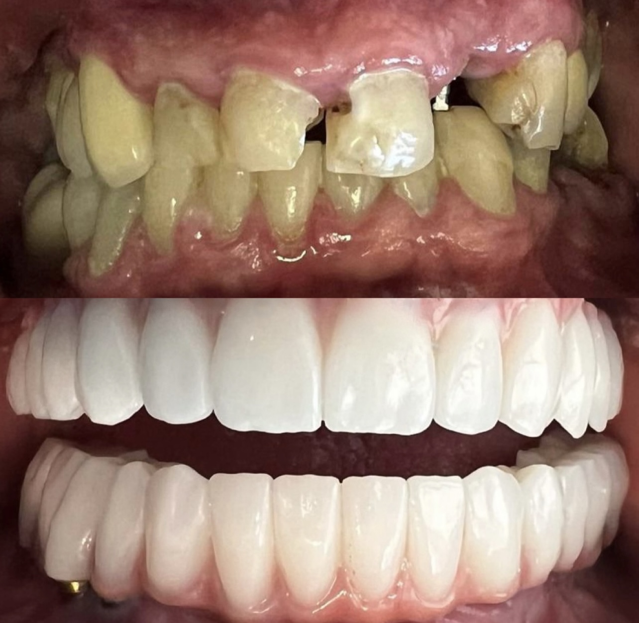 Case 01: Two stacked close-up views of teeth and gums.