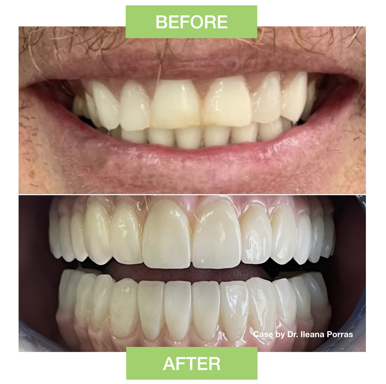 Case 03: Two stacked dental photographs with embedded Before and After labels and a clinician credit.
