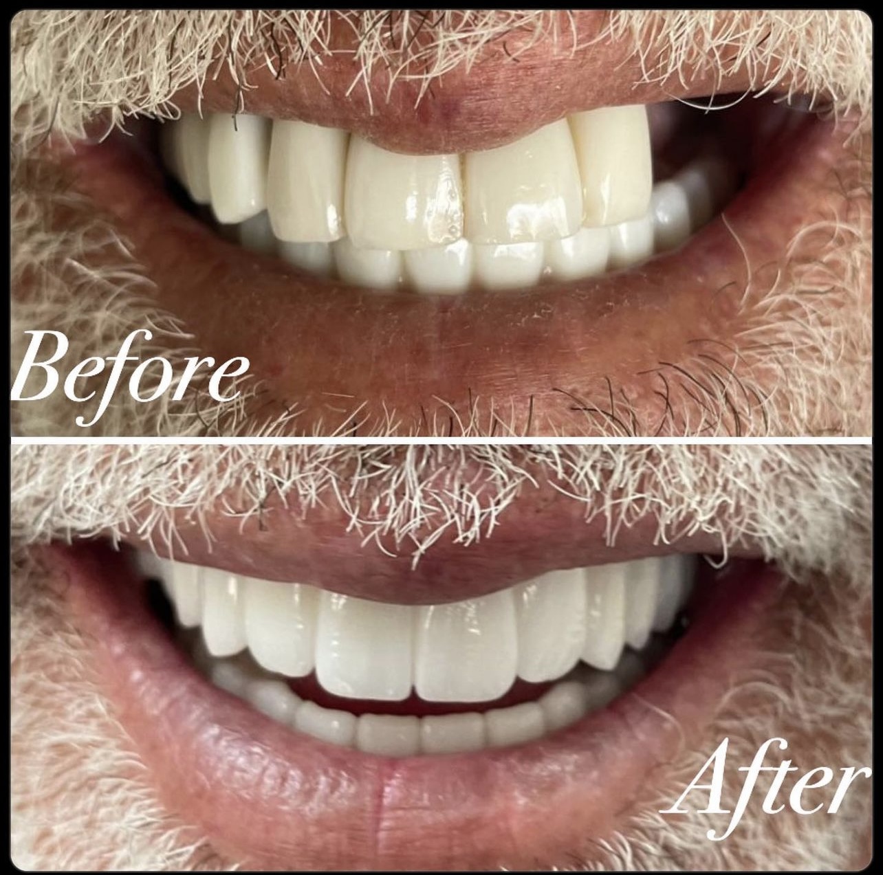 Case 04: Two stacked smile photographs with embedded Before and After labels.