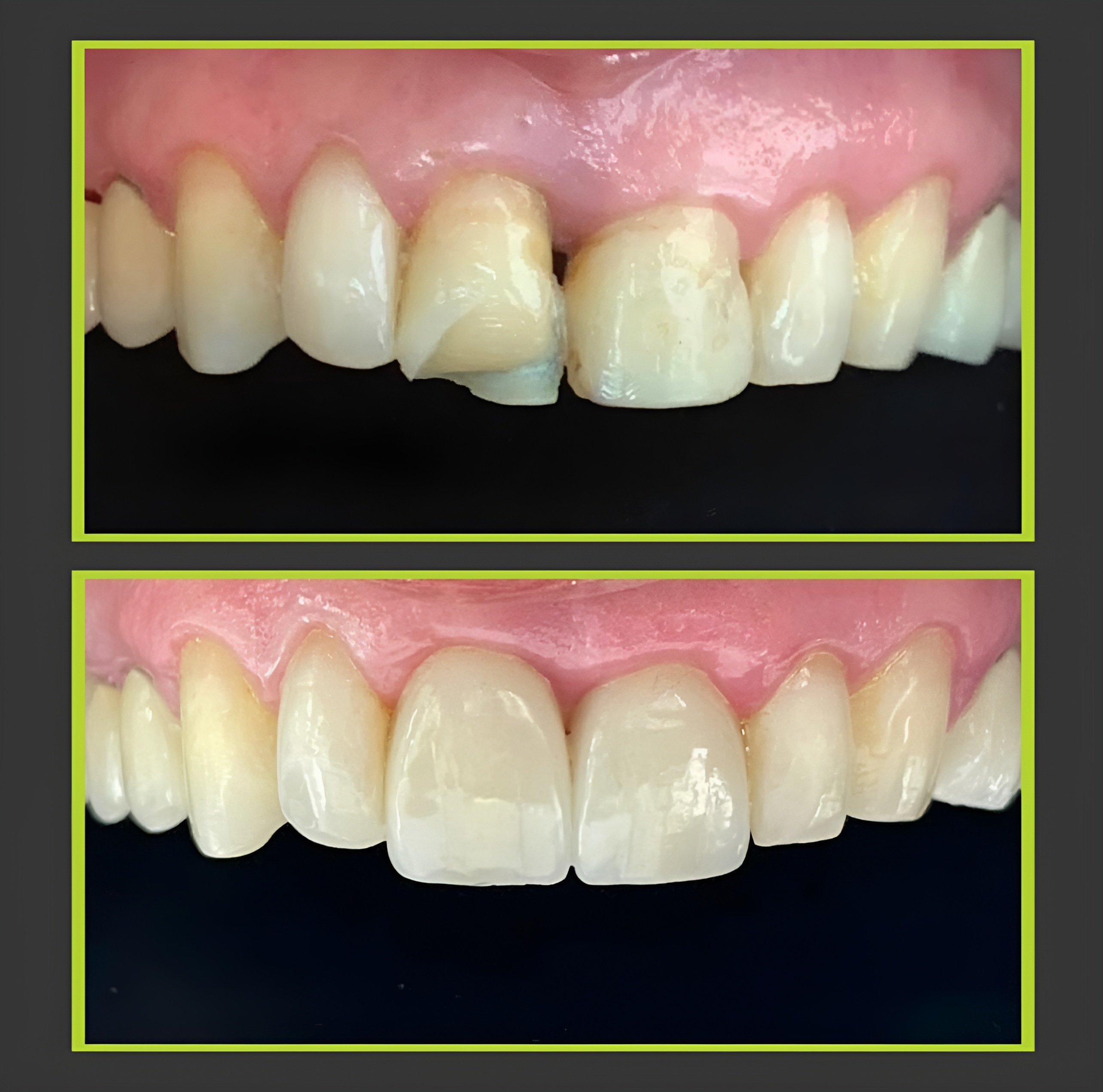 Case 05: Two stacked close-up views of upper front teeth in green borders.