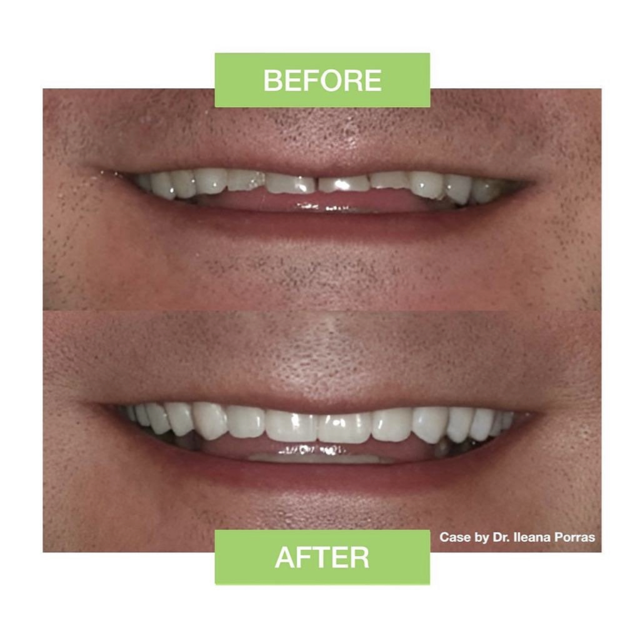 Case 06: Two stacked smile photographs with green Before and After labels and a clinician credit.